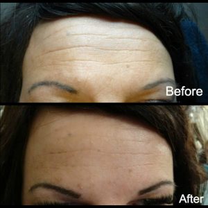 Significant reduction of forehead lines after a first treatment of botox in both these clients. The effects start after 3 days and continue to improve for the first 2 weeks. The effects can be expected to last approximately 4 months