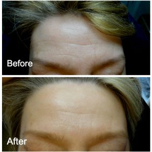 Two of our clients who have had treatments of their forehead areas using antiwrinkle injections with dramatic improvement in deep lines. If they continue with the treatment the lines will disappear completely.