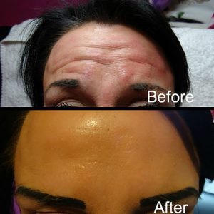 Two of our clients who have had treatments of their forehead areas using antiwrinkle injections with dramatic improvement in deep lines. If they continue with the treatment the lines will disappear completely.