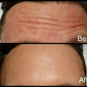 Two of our clients who have had treatments of their forehead areas using antiwrinkle injections with dramatic improvement in deep lines. If they continue with the treatment the lines will disappear completely.