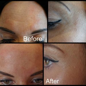 One of our clients after two areas of treatment with antiwrinkle injections over the forehead area and the and crows feet area.
