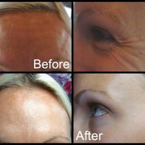 Actual results from treatment of forehead lines and crows feet demonstrated here. Here both clients have had deep lines dramatically improved and attend regularly for their 4 monthly treatments.