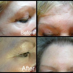 Actual results from treatment of forehead lines and crows feet demonstrated here. Here both clients have had deep lines dramatically improved and attend regularly for their 4 monthly treatments.