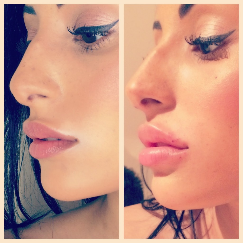 Beauty Naturale ,Non-surgical treatments, Anti-wrinkle, Botox,