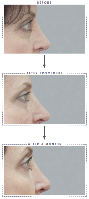 before and after mesotherapy Beauty Naturale ,Non-surgical treatments, Anti-wrinkle, Botox,