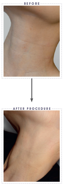 neck-mesotherapy-treatment Beauty Naturale ,Non-surgical treatments, Anti-wrinkle, Botox,