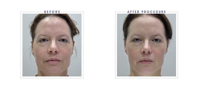 transformation-mesotherapy Beauty Naturale ,Non-surgical treatments, Anti-wrinkle, Botox,